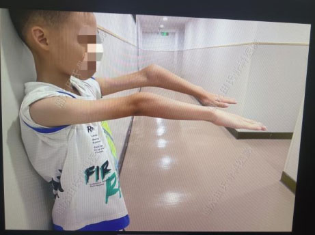 手指离断再植案例(图8) 1715776091420.jpg