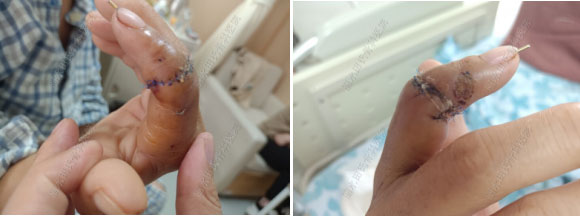 手指离断再植案例(图7) 1715775864123.jpg